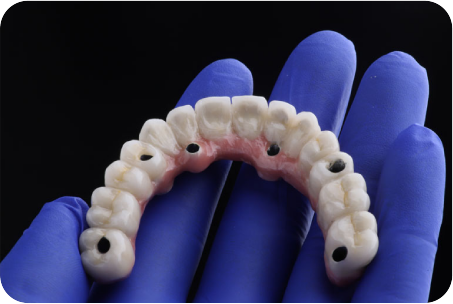 All-on-X implant concept