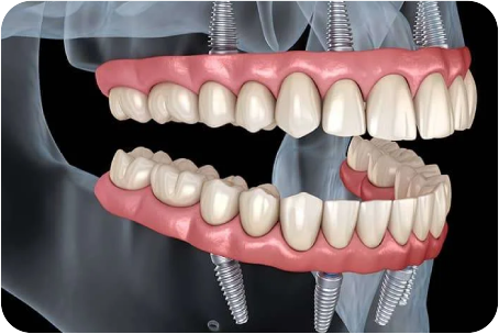 Full mouth dental implants