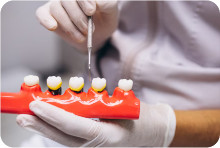 Dental implants